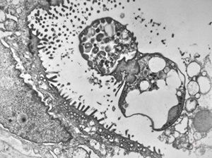M,33y. | cryptosporidiosis - duodenum, im | munodeficient pacient M,33y. | cryptosporidiosis - duodenum, im | munodeficient pacient